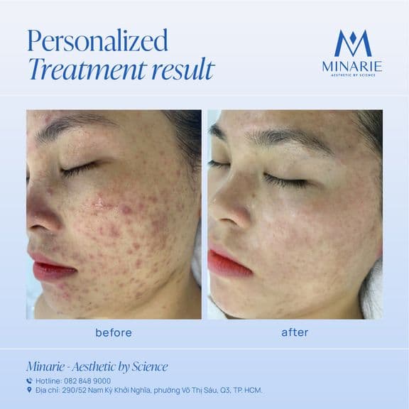 Feedback của khách sau 8 buổi trị mụn viêm với Acne-Fighting Program