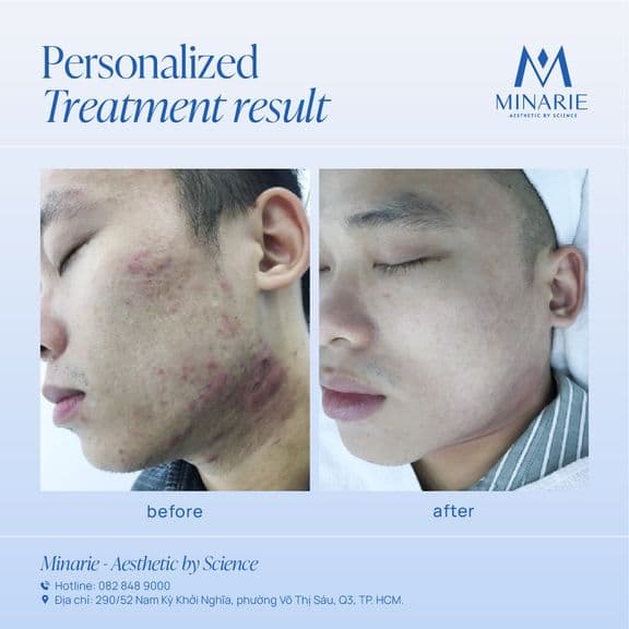 #FEEDBACK 45 NGÀY ĐIỀU TRỊ: SẠCH MỤN 7 NĂM