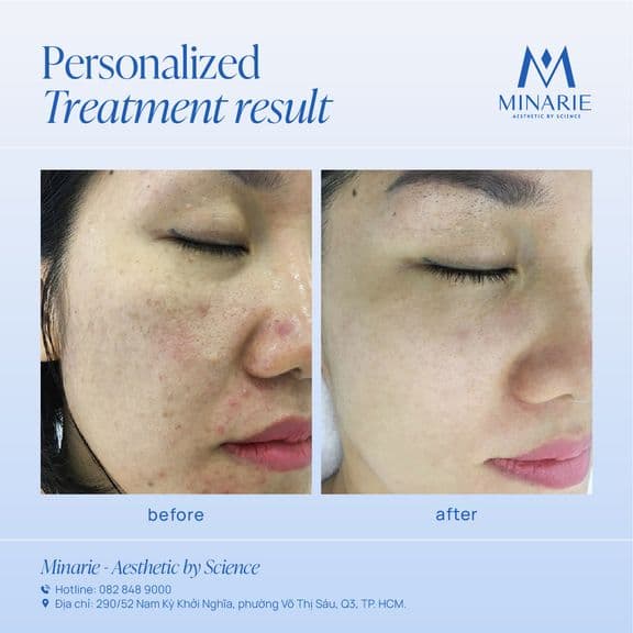 3 THÁNG ĐIỀU TRỊ MỤN TOÀN DIỆN