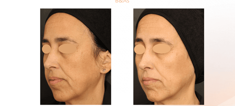 Indiba tại Minarie